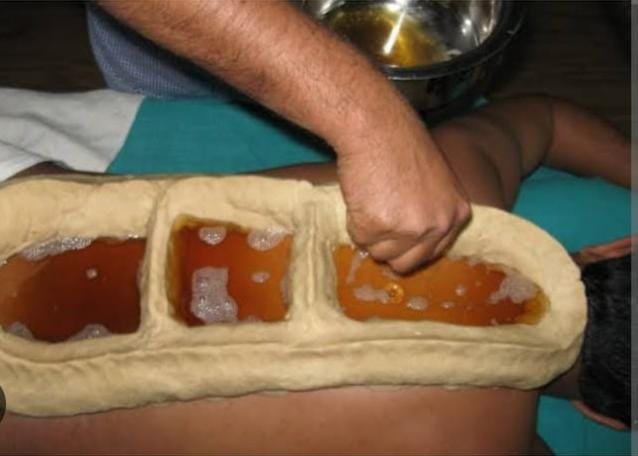 Prishta Basti Ayurvedic therapy - lower back pain relief with medicated oils