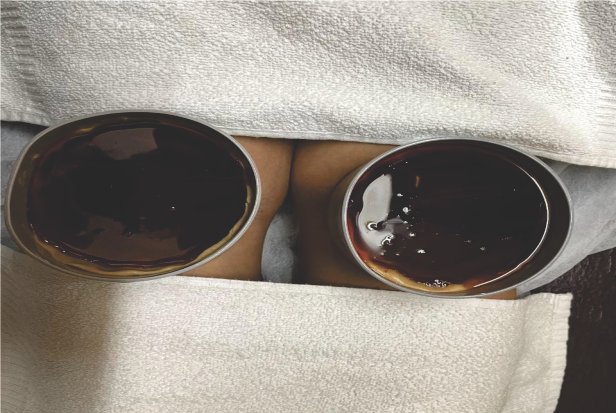 Janu Basti Ayurvedic Therapy for Knee Pain and Arthritis Relief