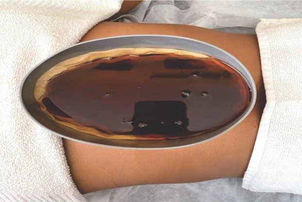 Kati Basti Ayurvedic therapy - lower back pain relief