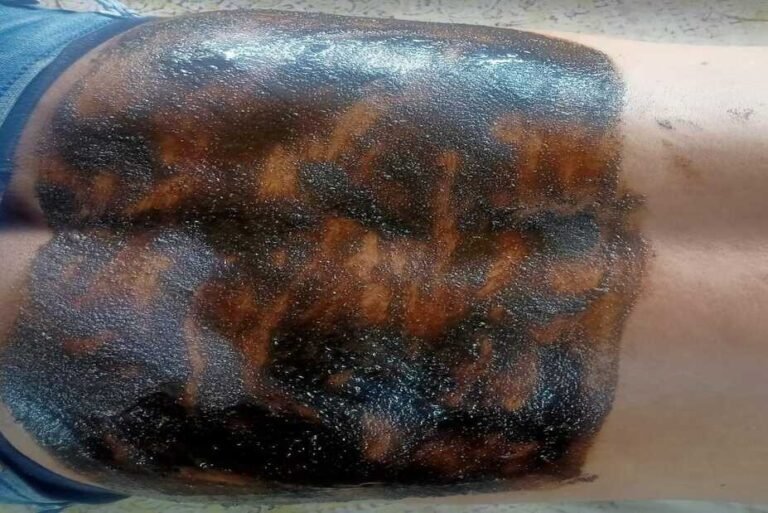 Udvartana Ayurvedic herbal powder massage - body detox and skin rejuvenation