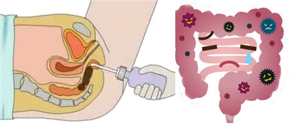 Panchakarma Basti therapy at Ashtanga Ayurved hospital in Nashik